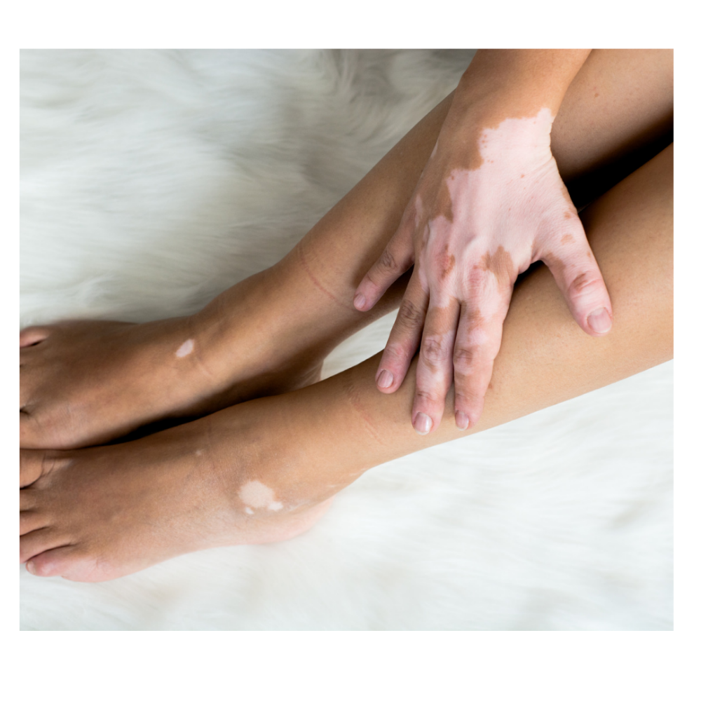 VITILIGO CAMOUFLAGE