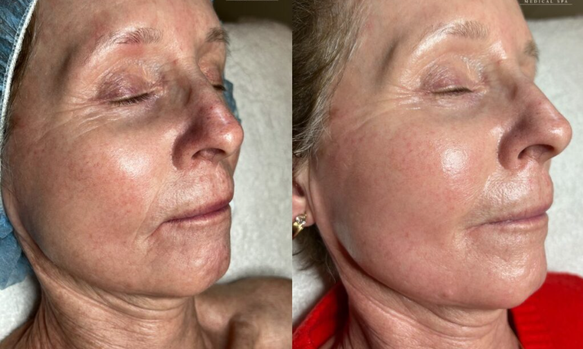 Classic Glow Facial