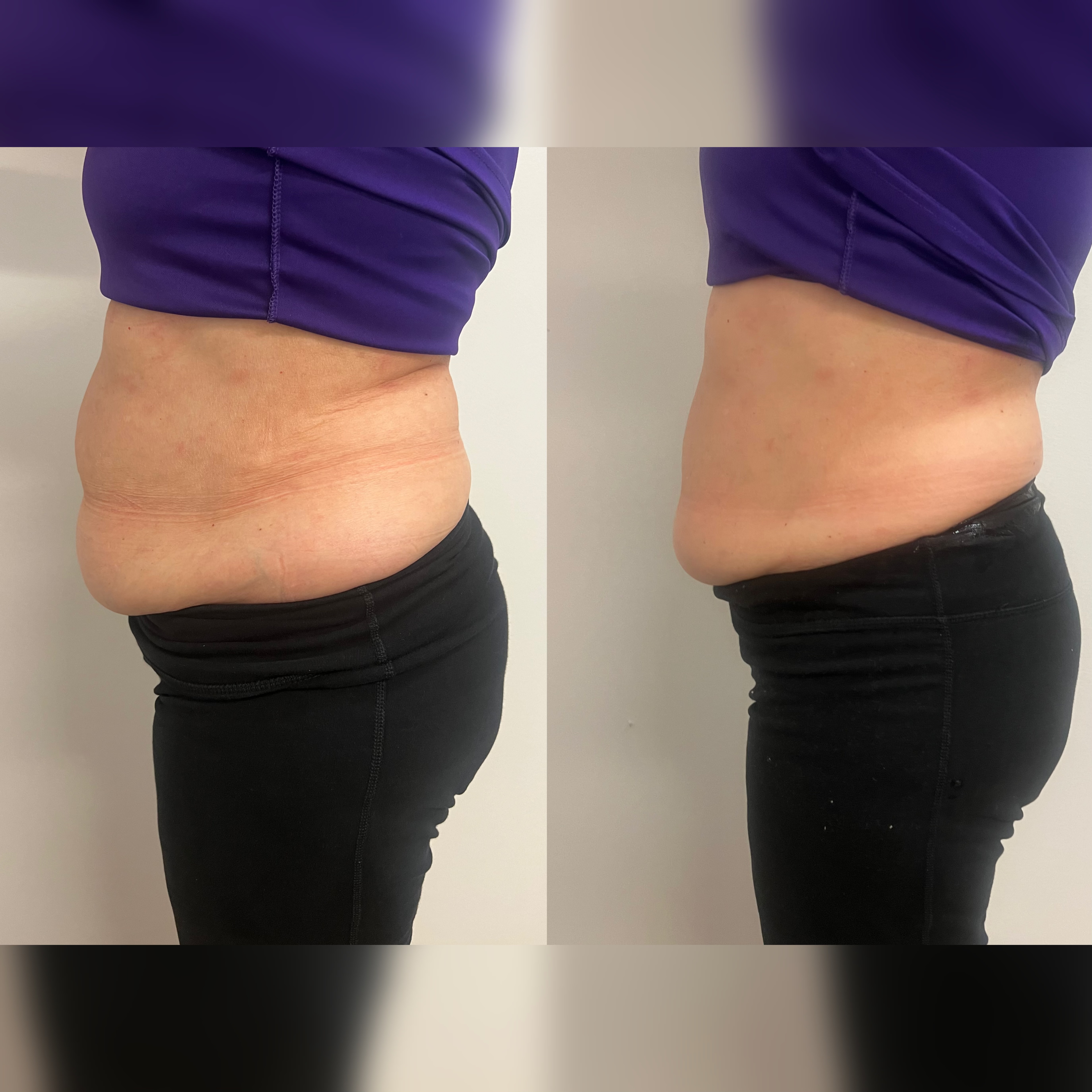 1 Hour Tummy Tuck