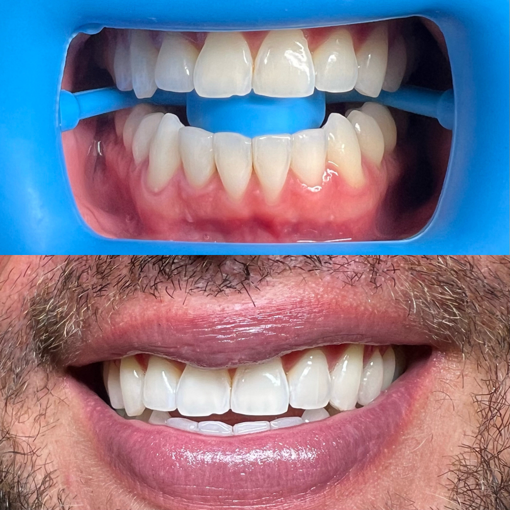 60 Minute Teeth Whitening Session