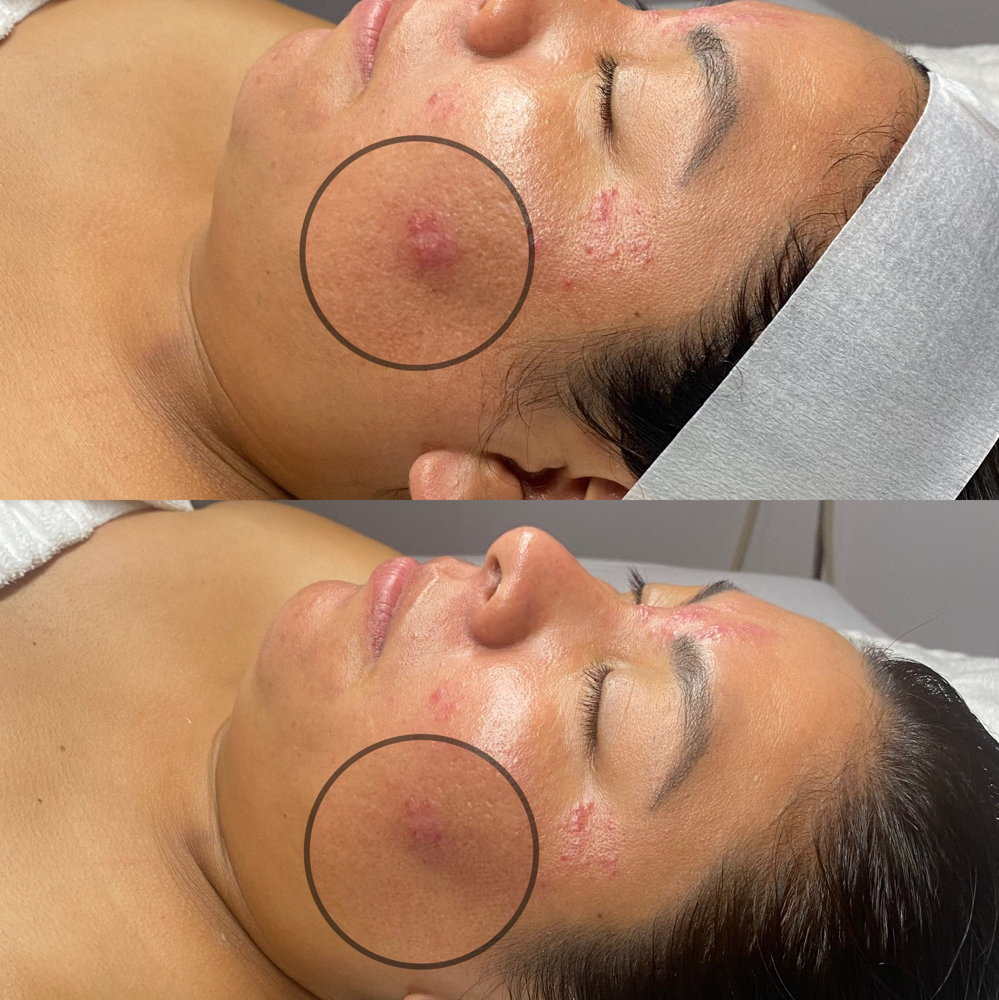 Acne Facial