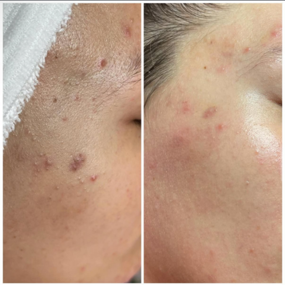 🌸 Acne / Clarifying Facial at Angels Aesthetics ABQ in Albuquerque, NM