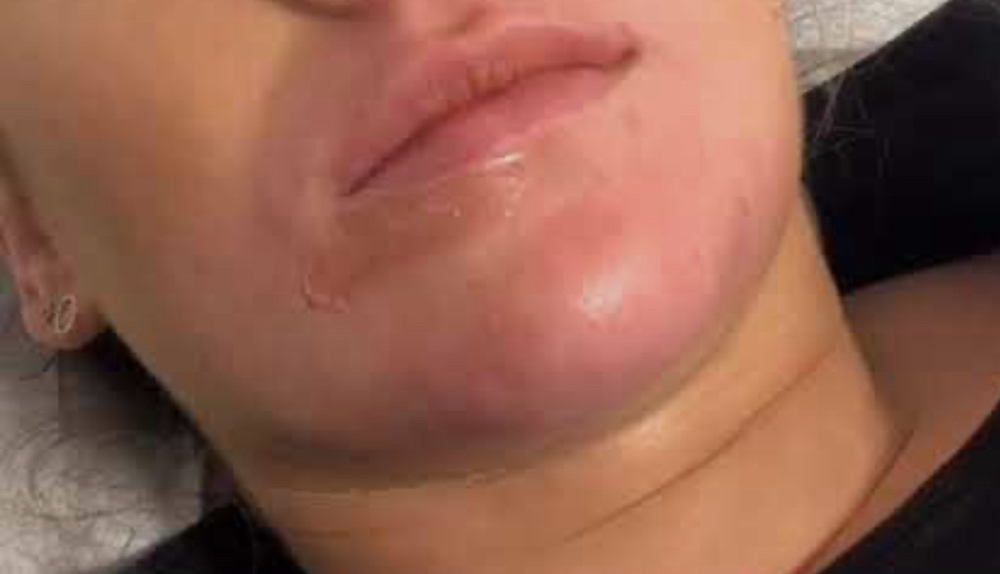 Lower Lip.