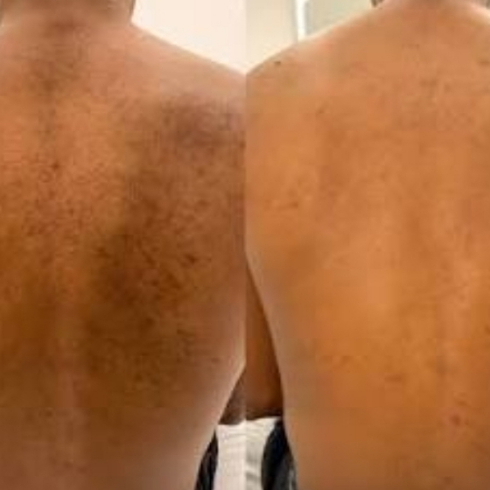 Back Chemical Peel at Basic and Beyond Brows in Lakewood, CA