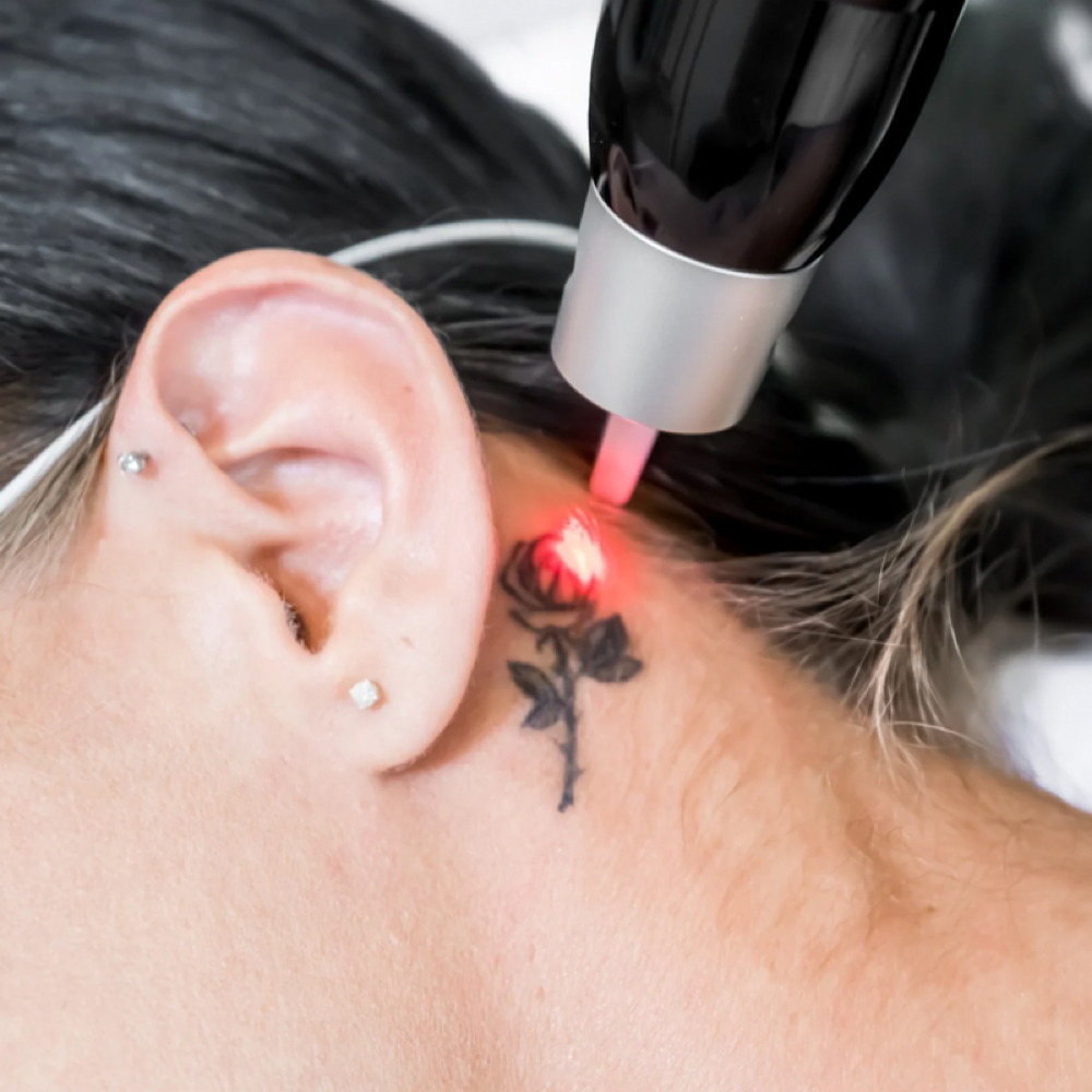 Tattoo Removal