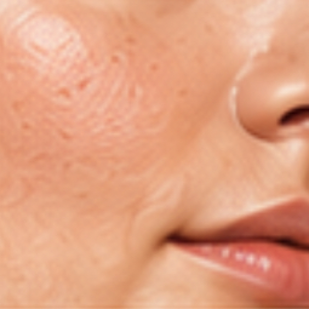 Skin Texture Refinement at Plasmalift Skin Clinic LLC in Bettendorf, IA