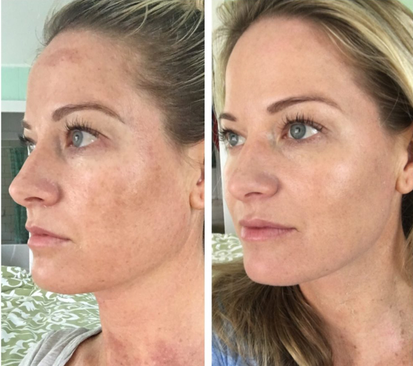TCA Resurfacing at Faces by DeAngela in New Brockton, AL
