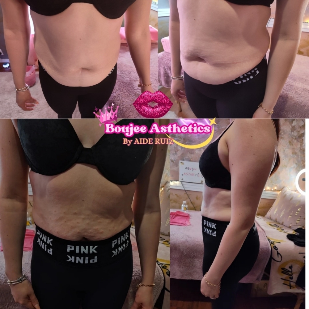 LIPO BOTTLES at Boujee Asthetics ✨ in Tucson, AZ