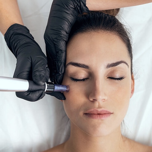 Microchanneling (Skin Needling)