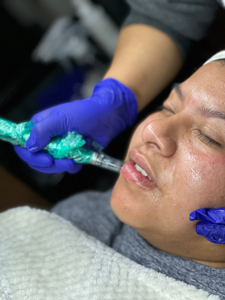 Microneedling Treatment