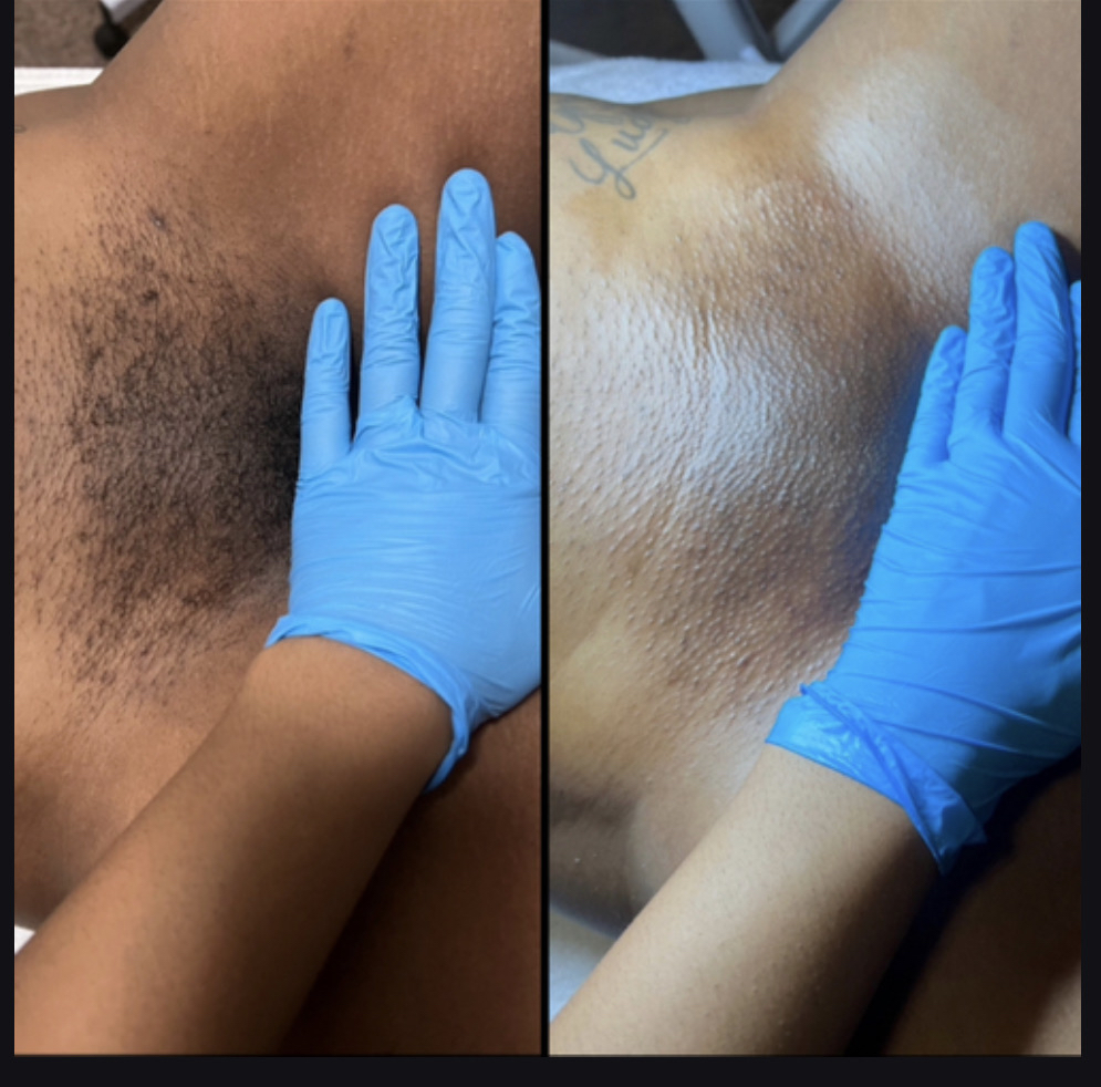 Brazilian Wax