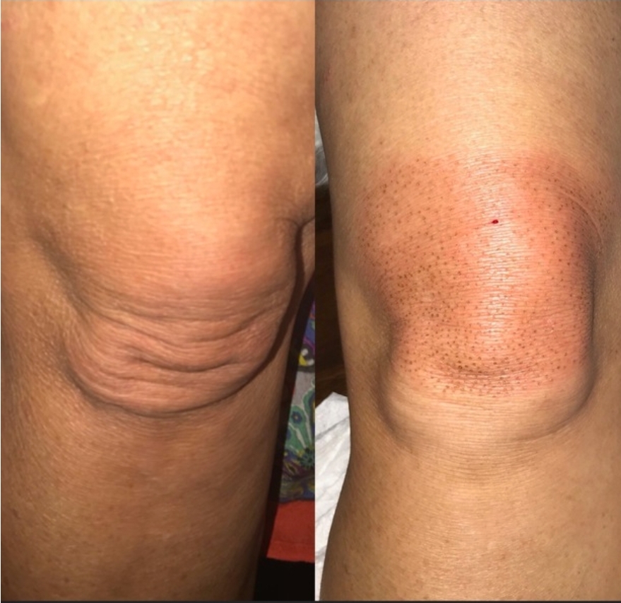 Fibroblast Lift Knees
