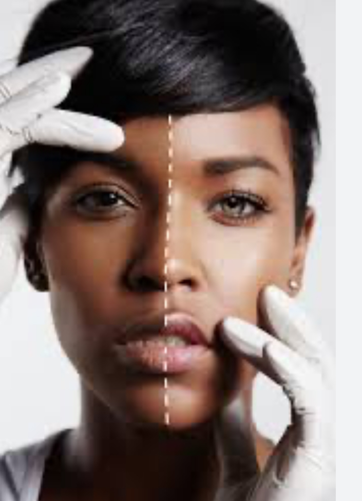 Chemical Peels