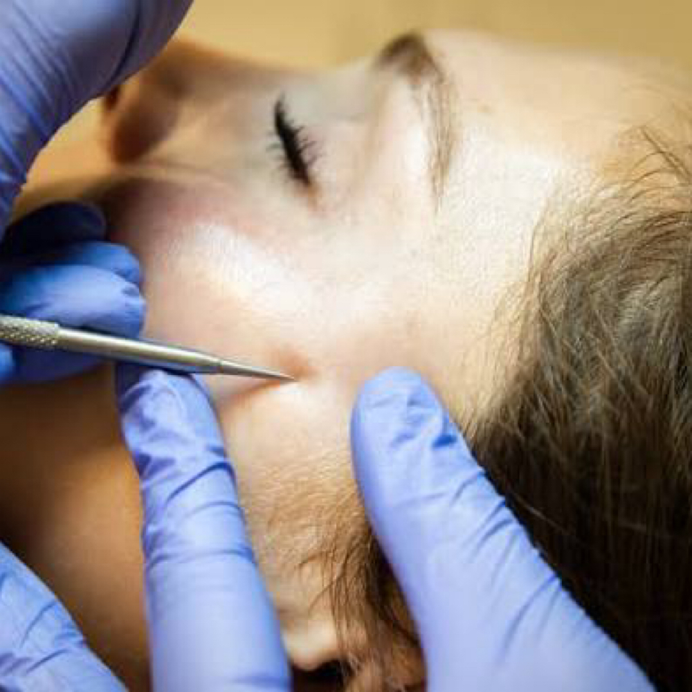 Milia Extractions at Ty Thomas Aesthetics in Annapolis, MD