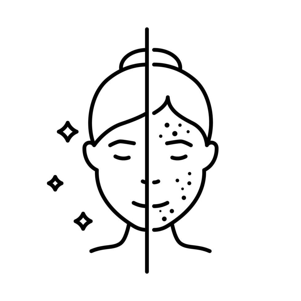 Acne Facial