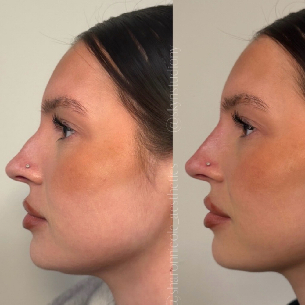 Nose Filler at Sharon Nicole Aesthetics in Patchogue, NY