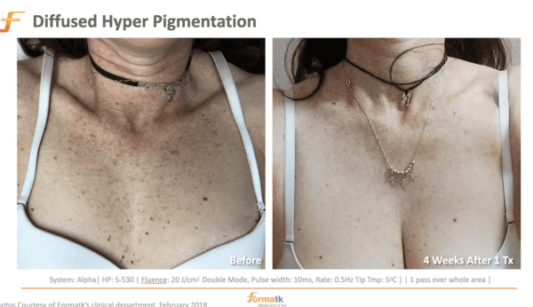 Pigmented Lesions at Elegant Esthetics By Jozlyn in Lamar, CO