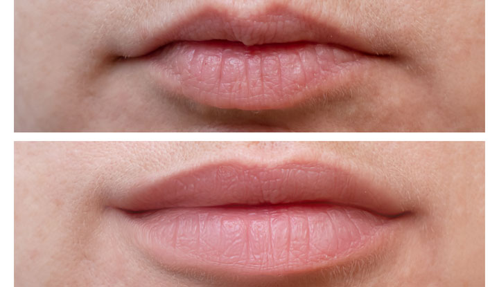 Lip Flip at Milk & Honey Aesthetics in Sugar Land, TX