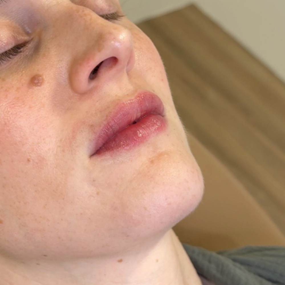 Lip Enhancement at sinä aesthetics + wellness in South Hadley, MA