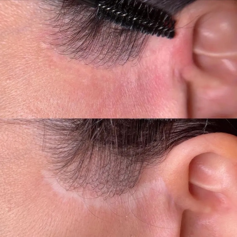 Scar Camouflage at Certified permanent makeup services in Newport Beach in Newport Beach, CA