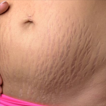 2 Area Stretch Mark CoverUP Package at Cosmetic Studio 54 in Los Angeles, CA