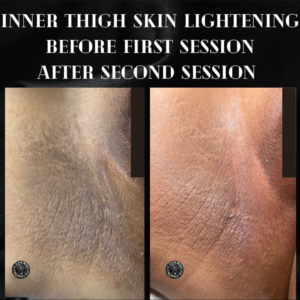Inner Thigh Skin Correction