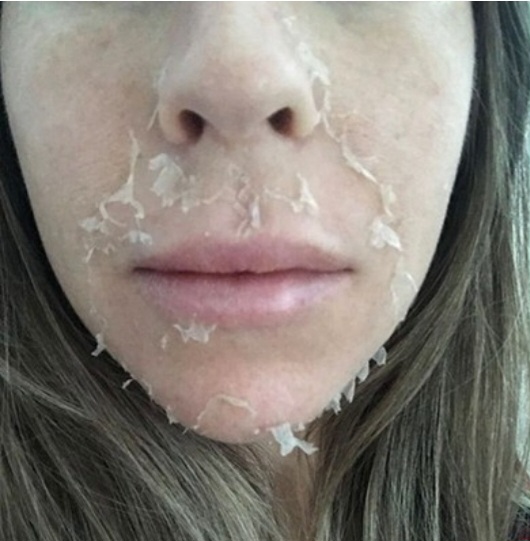 Miracle Peel