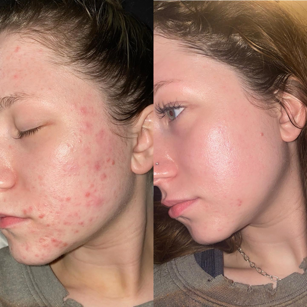 Face Reality Acne Bootcamp Facial