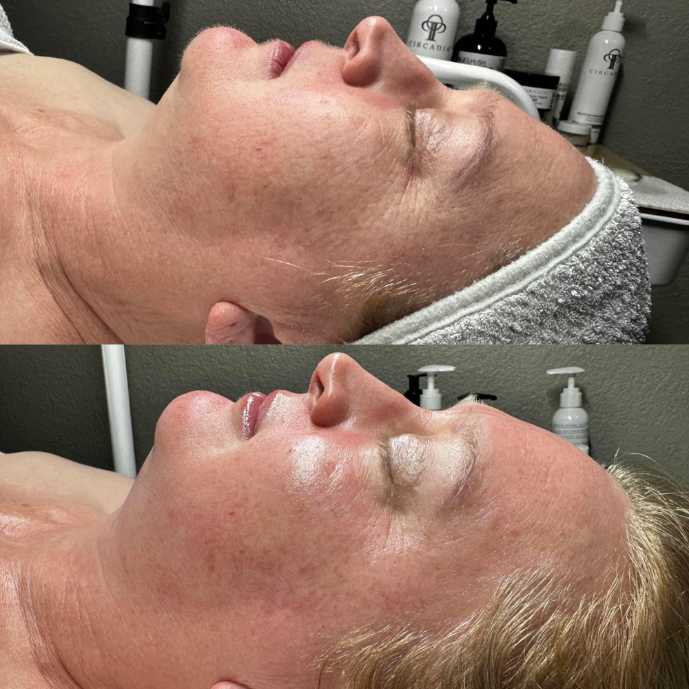 Chemical Peels