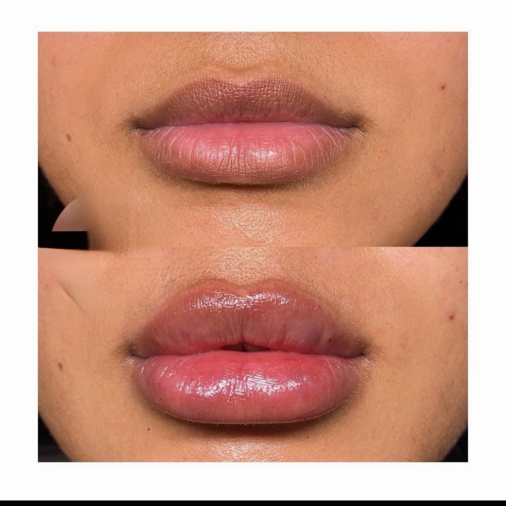 Lip Filler at Ayona’s Medspa and Beauty Bar in Newnan, GA