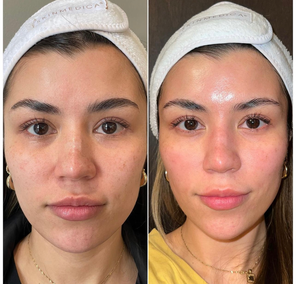 Microneedling