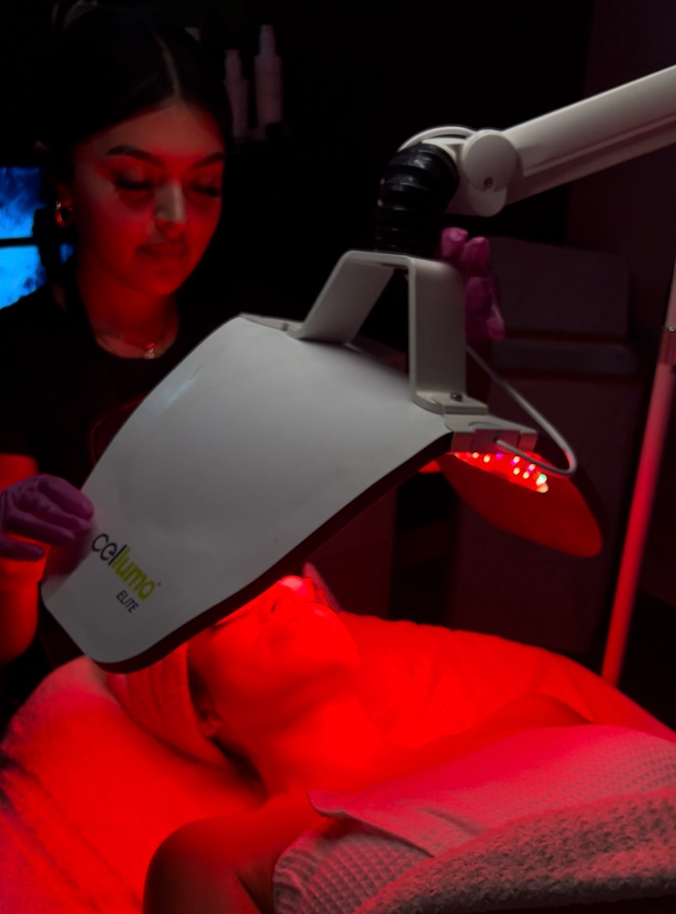 Microneedling at Celestial Aesthetics in College Station, TX