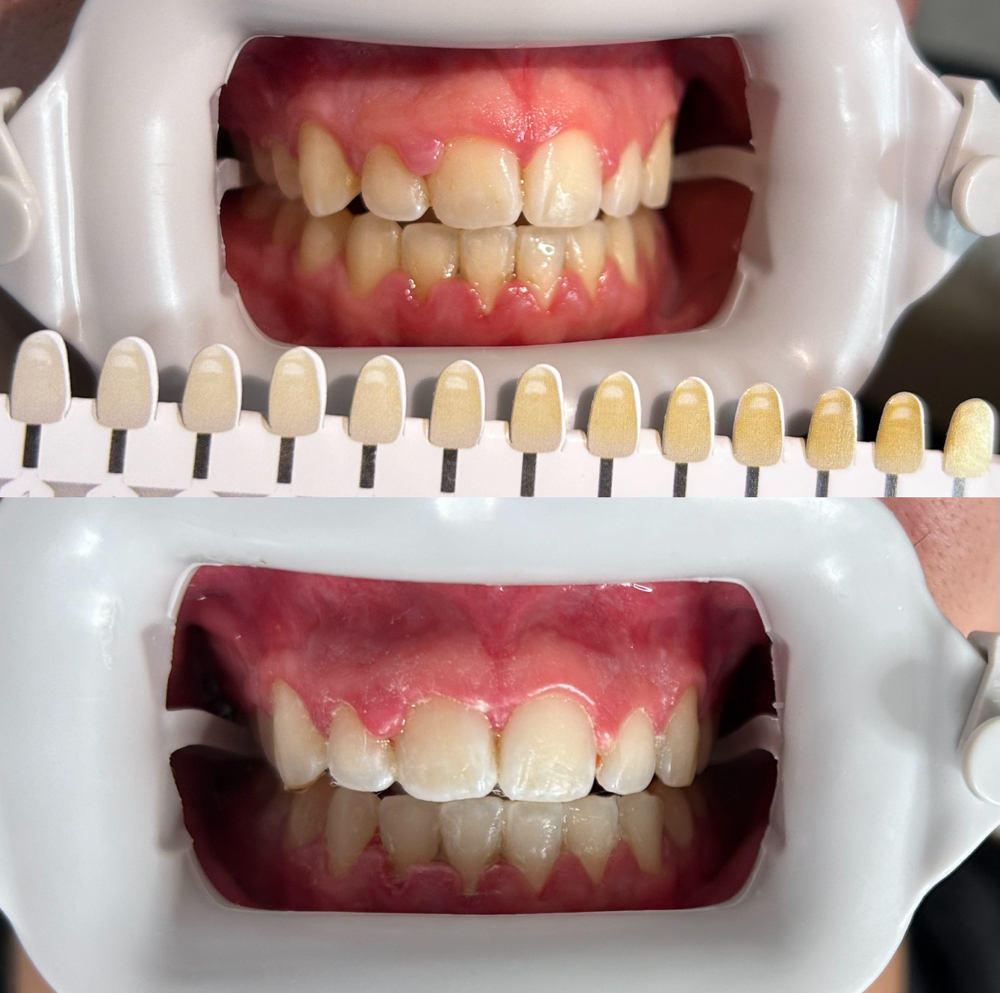 60 Min Teeth Whitening