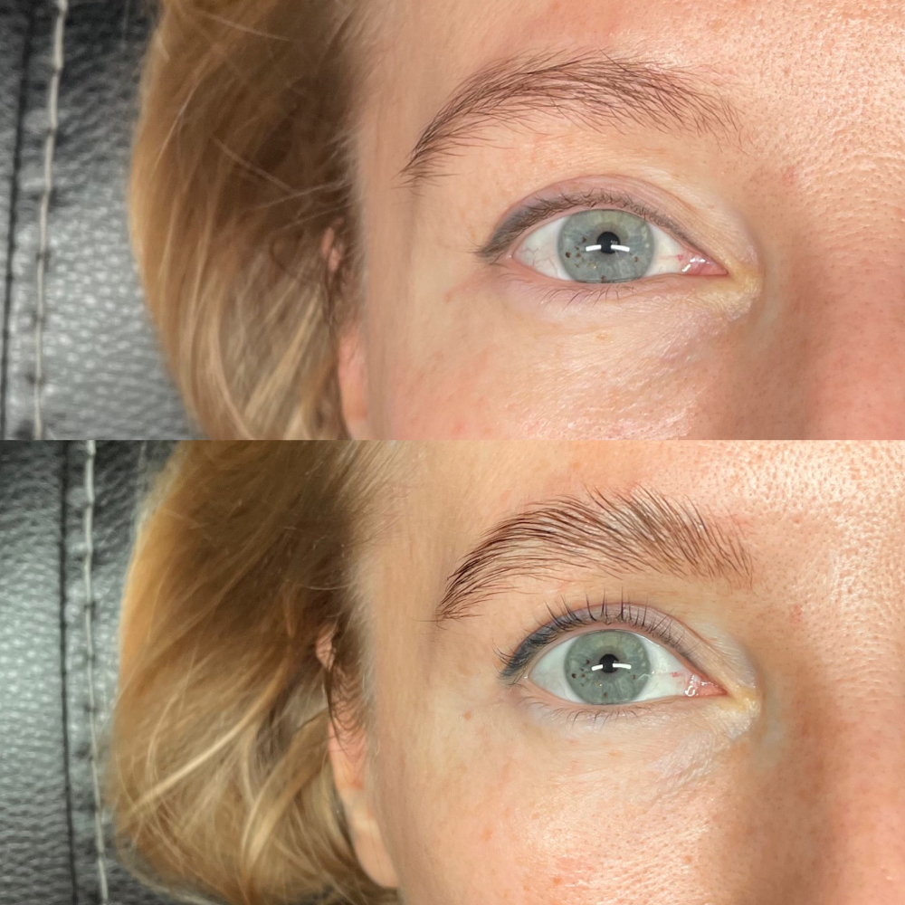 Brow Lift