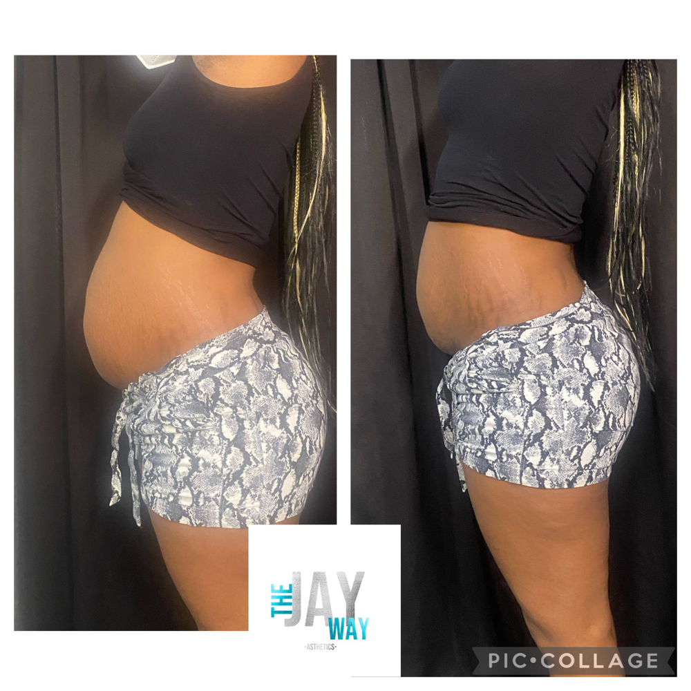 Body Cavitation