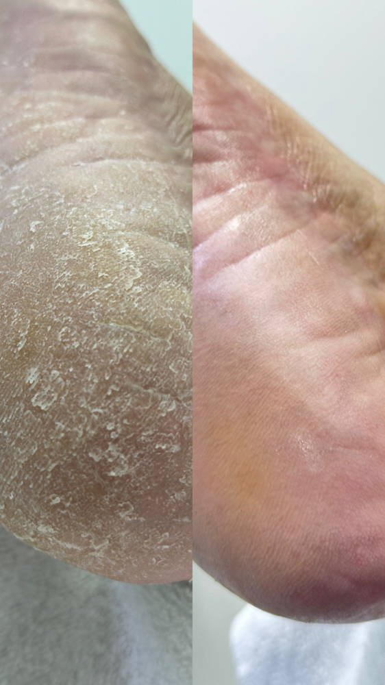 Callus Treatmen Work at Blue Olas Spa in Ocoee, FL