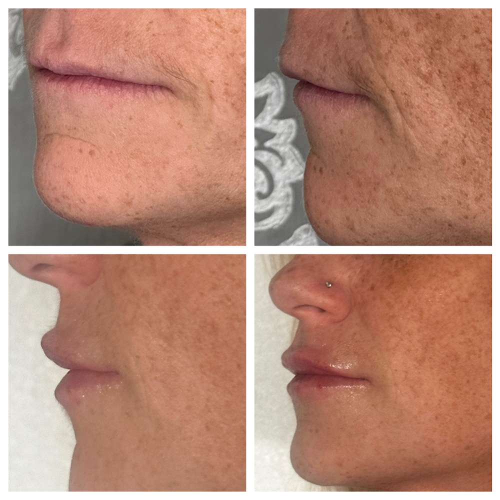 Lip Filler at SCL Aesthetics in Putnam, CT