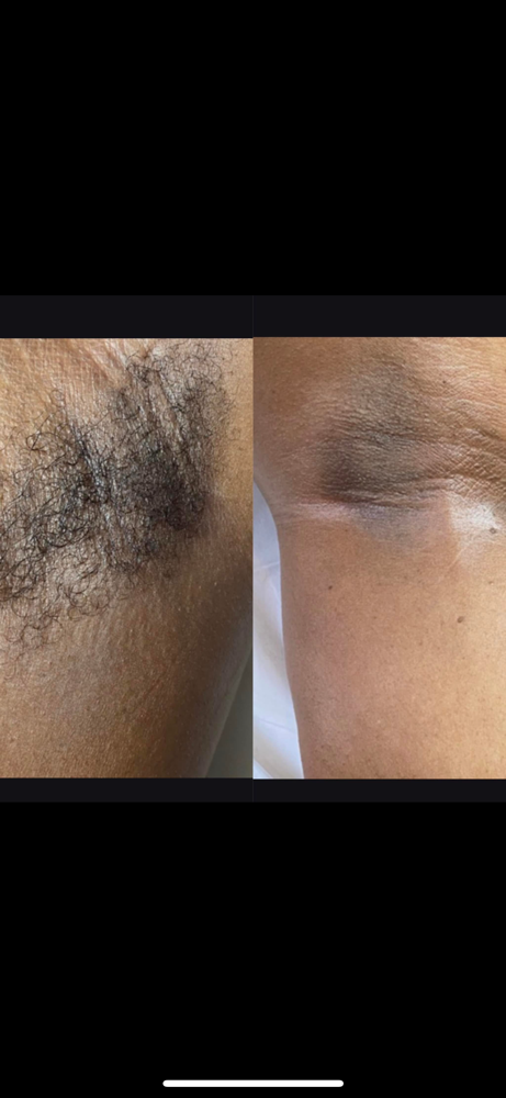 Axilla(Under Arm) Wax