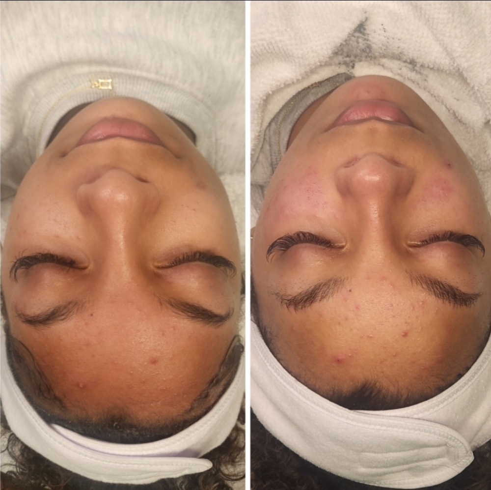 Teen Facial