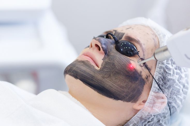 Laser Carbon Peel