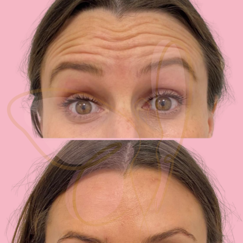 Botox at Absolut Health and Wellness in Atlanta, GA