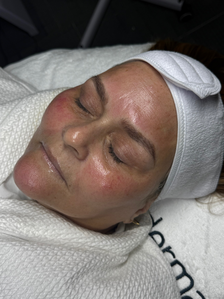 Microagujas+ Facial Antiaging at YubyRo in San Juan, PR