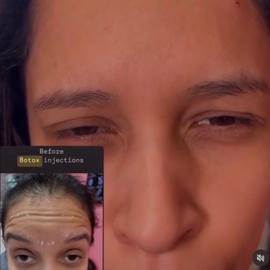 Botox/Xeomin Injections at TLN AESTHETICS MEDSPA in Lanham, MD