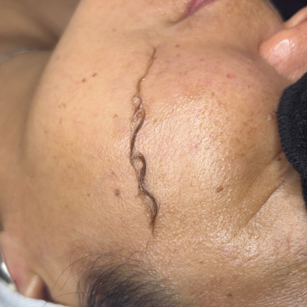 The Smooth & Glow Dermaplane Facial at Newskinbykylie in Rockledge, FL