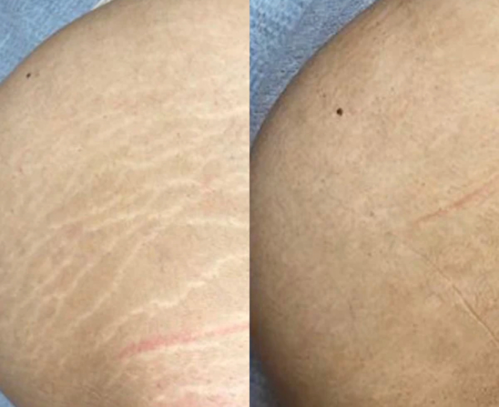 Camoflauge Stretchmark Tattooing