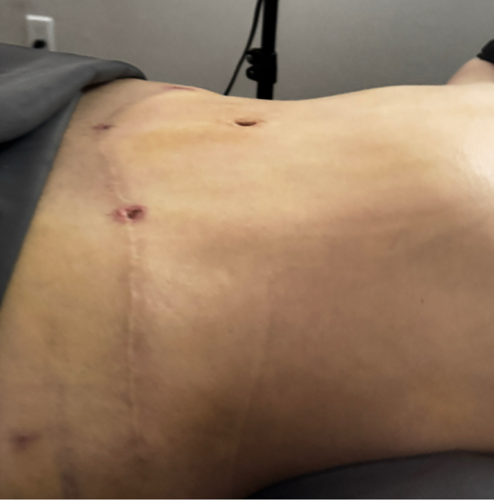 10 sesions Post-op 2 Or More Zones