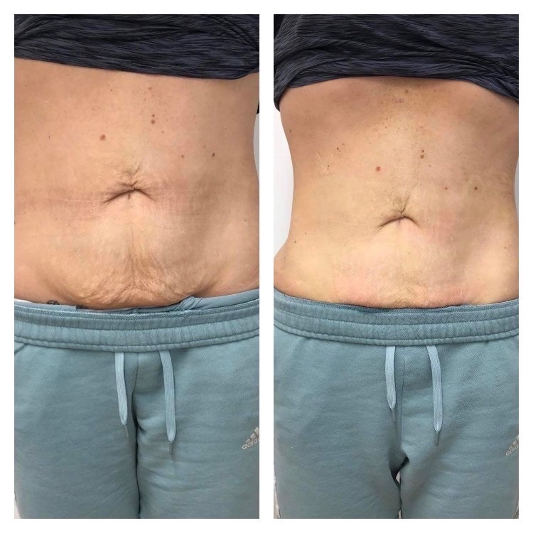 6-High RF Antiaging Package