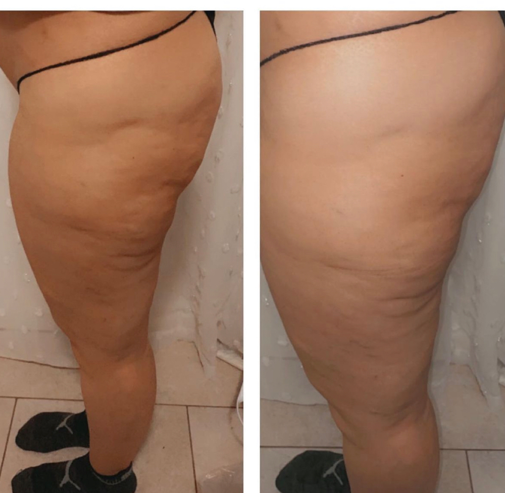 Leg Cellulite 4 Sessions