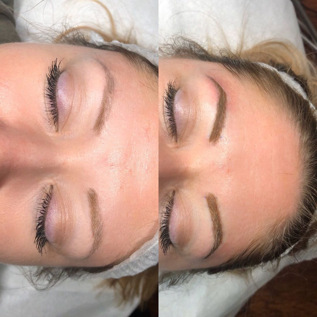 Brow Consultation