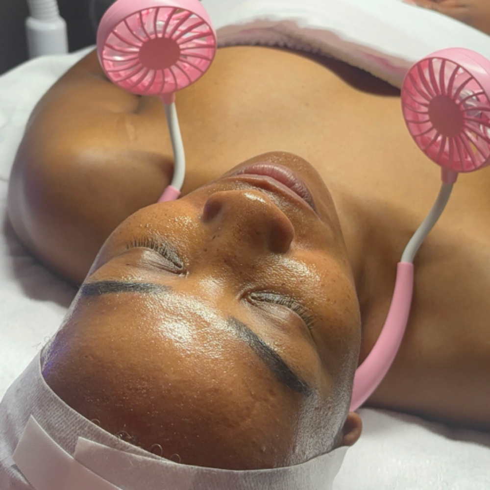 TCA chemical peel at Zelle Aesthetics in Bedford, TX